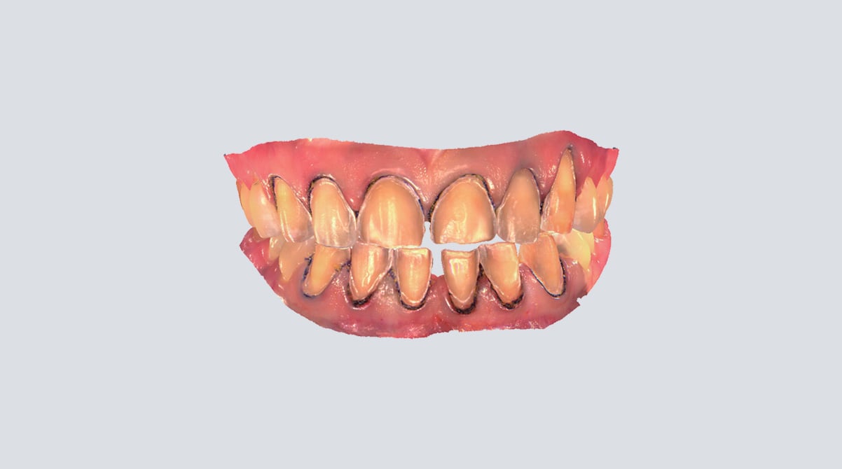 Aoralscan 3 используется для получения высокоточных цифровых оттисков виниров