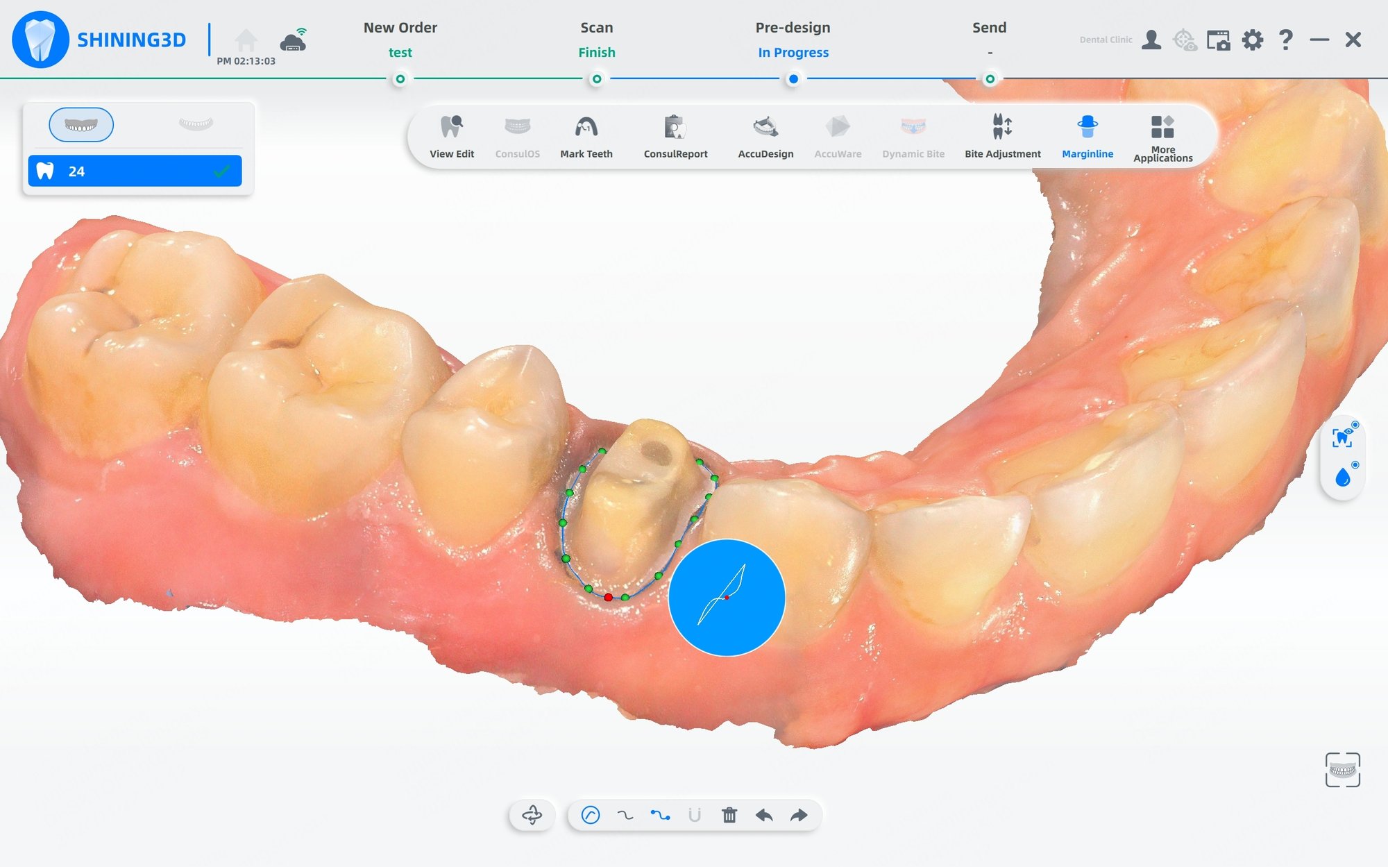 Aoralscan 3 интраоральный сканер Margin Line Auto Extraction fuction
